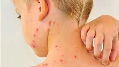 أمريكا تشهد أكبر موجة تفش للحصبة خلال 10 سنوات