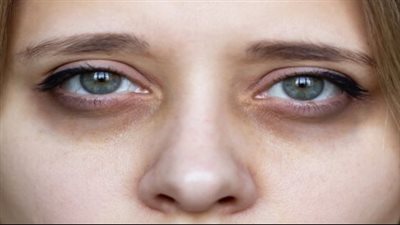  الهالات السوداء، أسبابها وعلاجاتها وكيفية الوقاية منها