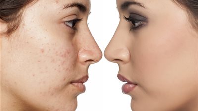 من مطبخك، 10 علاجات للبثور وحب الشباب