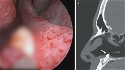 شاب أمريكي يتفاجأ بنمو ضرس في مكان غريب