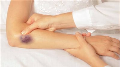 احذر من كدمات الجلد، أهم أعراض النزيف الداخلي