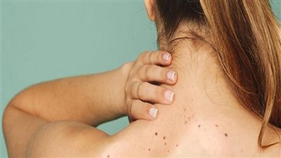 طرق التخلص من حب الشباب في الظهر 