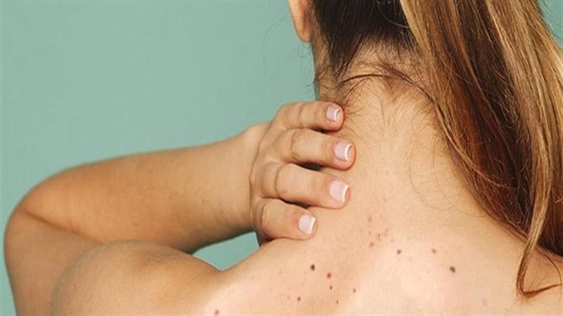 علاج حبوب الظهر،