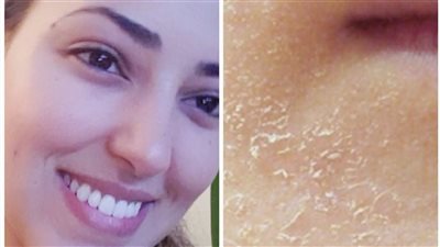  قناع طبيعي يخلصك من قشور البشرة بمكونات بسيطة 