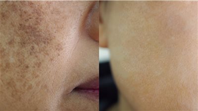 قناع طبيعي يخلصك من كلف البشرة 