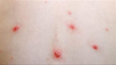 صحة المنوفية تكشف نتائج فحص 500 تلميذ بعد رصد إصابات بالجدري المائي