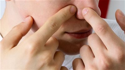 وصفات طبيعية لعلاج الرؤوس السوداء من البشرة