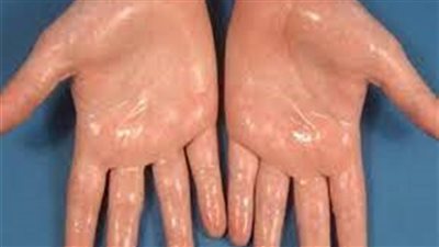 أسباب تعرق اليدين عند الأطفال وطرق العلاج 