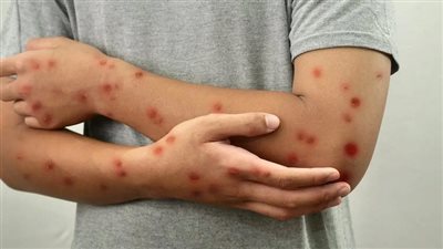 حالات الحصبة تزداد في أمريكا والمرض ينتشر في 25 ولاية 