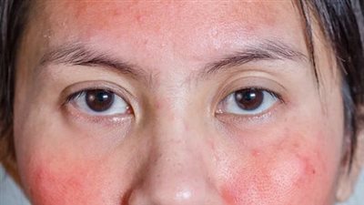 قناع طبيعي يخلصك من التهابات البشرة 