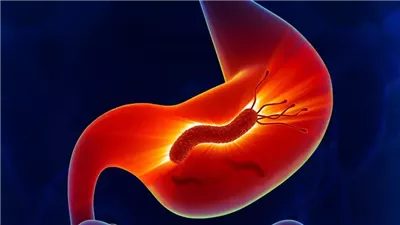 أعراض وأسباب جرثومة المعدة وأفضل طرق علاجها