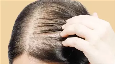 وصفة طبيعية تساعد على علاج الصلع عند النساء 