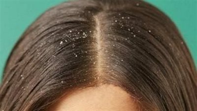 وصفة طبيعية تقضى على قشرة الشعر بعد انتهاء الشتاء 