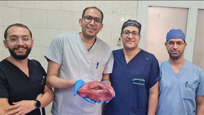 استئصال طحال متضخم يزن 2 كيلو من مريضة بمستشفى أسيوط العام (صور)