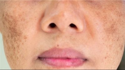 قناع طبيعي يخلصك من بقع البشرة ويعيد جمالها