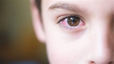 الصحة تحذر من 5 أعراض للإصابة بمرض الرمد الربيعي