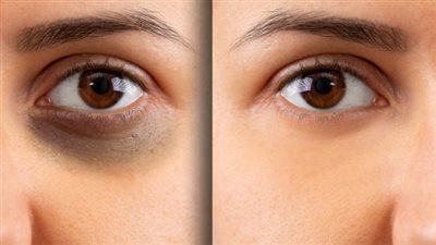 قناع الخيار والبطاطس للتخلص من الهالات السوداء 