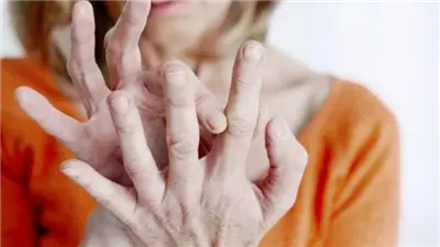  أعراض الروماتويد لدى النساء وطرق العلاج المنزلي