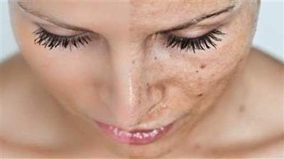 قناع طبيعي يخلصك من كلف الوجه بعد الولادة 