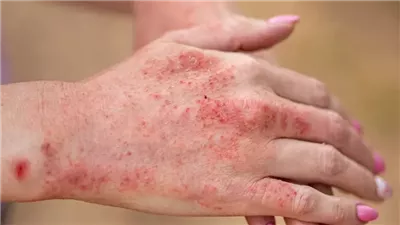  طبيب مناعة: مرض 