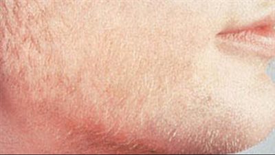 أعراض ارتفاع هرمون الذكورة عند النساء وأسباب ذلك ومخاطره