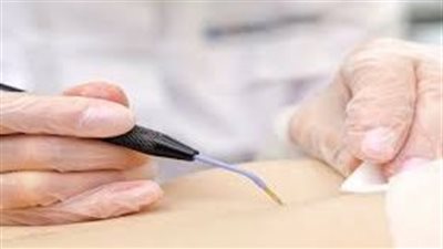 تفسير حلم الكي بالنار في المنام وعلاقته بالإسراف في أمور غير صالحة 