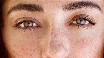 نصائح تساعدك في تقليل ظهور النمش بالبشرة، تعرف عليها