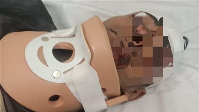 لأول مرة بصحة الدقهلية، نجاح جراحة دقيقة لإصلاح كسر بالرقبة في مستشفى تمى الأمديد