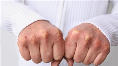 وصفات طبيعية لعلاج تشققات اليدين وزيادة نعومتها 