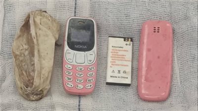 ابتلعه من 4 أشهر، استخراج هاتف محمول من معدة مريض بمستشفى ناصر التخصصي