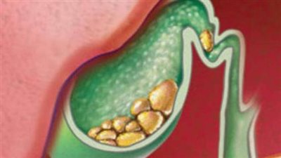 أسباب تكون حصوات المرارة وأعراضها وطرق العلاج 