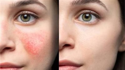 قناع طبيعي لتهدئة البشرة بعد التعرض للشمس 