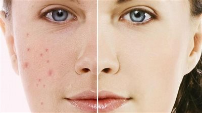 كلها موجودة في مطبخك، ماسكات طبيعية لعلاج حبوب الوجه