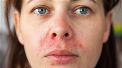 قناع طبيعي يساعد في علاج التهابات البشرة 