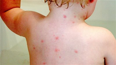 كيفية التفرقة بين الحساسية والجديري المائي والهربس عند الأطفال 