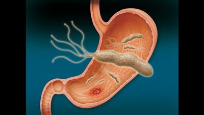 جرثومة المعدة، أعراضها وأسباب الإصابة وطرق الوقاية والعلاج 
