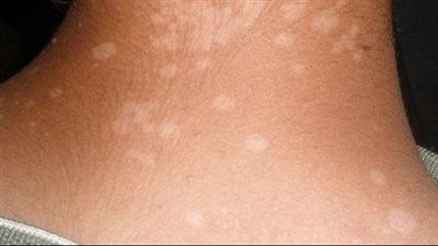 أعراض النخالة البيضاء عند الأطفال وأسبابها وطرق العلاج