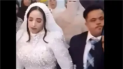 بعد زواج عريس بمتلازمة داون، هل ينتقل المرض بالوراثة وما هي أعراضه؟ 