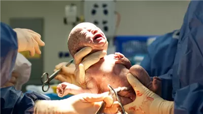 نجاح عملية ولادة قيصرية لثلاثة توائم بمستشفى العدوة بالمنيا