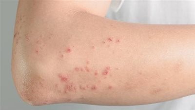 ما هي حساسية الدم وأعراضها وطرق علاجها في الحالات الطارئة؟