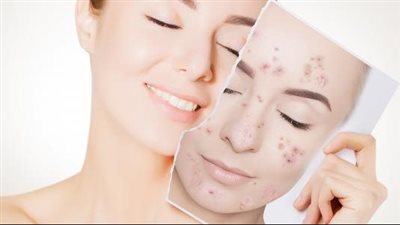 تخلصي من آثار حب الشباب بهذه المكونات 