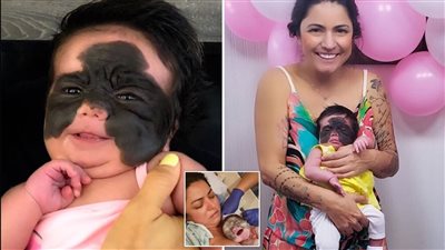 بعد 12 عملية جراحية.. أطباء يزيلون وحمة 