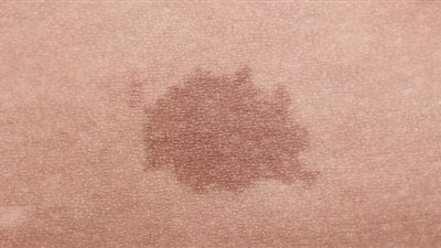 تحذير طبي: بعض الشامات يمكن أن تكون قاتلة