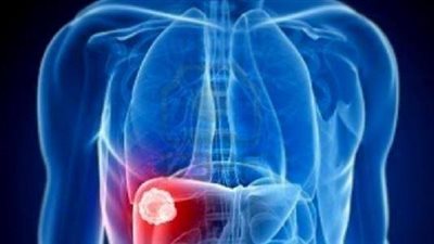 أسباب دهون الكبد.. وطرق اكتشافها 