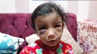 منظر يدمي القلوب.. أب يتفنن في تعذيب طفلته بالدقهلية.. ووالدته: ابني عاق ومتعود يضربنا | صور