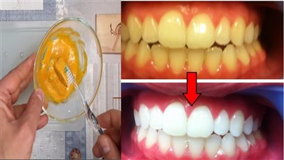 وصفات طبيعية وصحية لتبييض الأسنان في البيت
