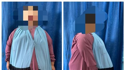 مستشفى أسيوط الجامعي تنجح في تكميم معدة لطفلة تعاني من سمنة مفرطة (صور) 