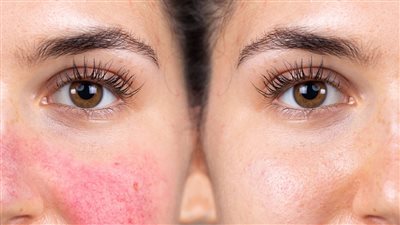 قناع طبيعي لعلاج التهابات البشرة في الطقس الحار 