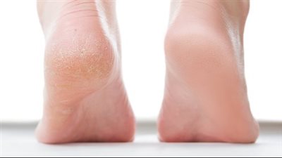 نصائح للعناية بالكعبين، خلال فصل الصيف وحمايتها من التشققات والجفاف