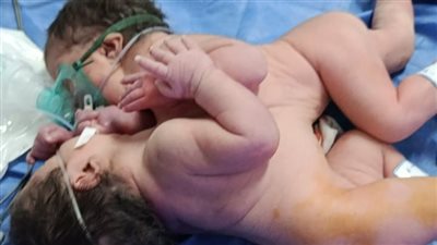 نجاح ولادة نادرة لتوأمين ملتصقين بمستشفى الفيوم العام